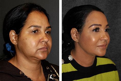 Facial Plastic Surgeon NYC .